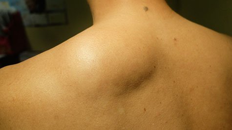 arlington dermatology lipomas 1138804682