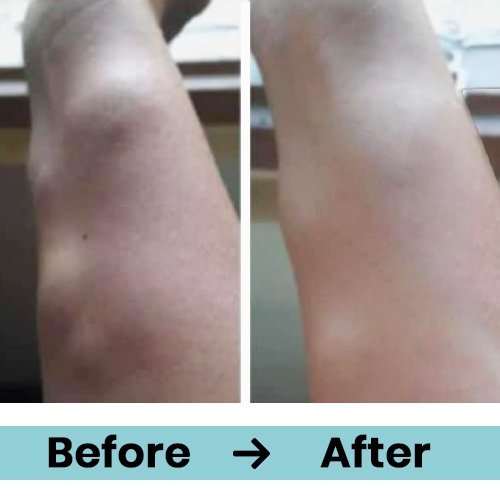 lipoma 2
