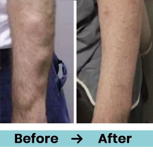 lipoma 3