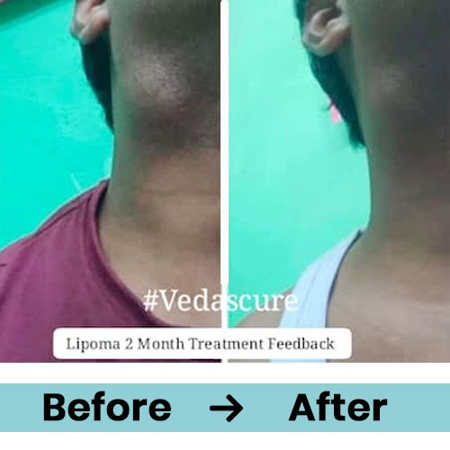 lipoma 4