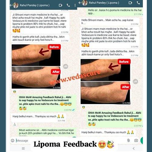 lipoma 6
