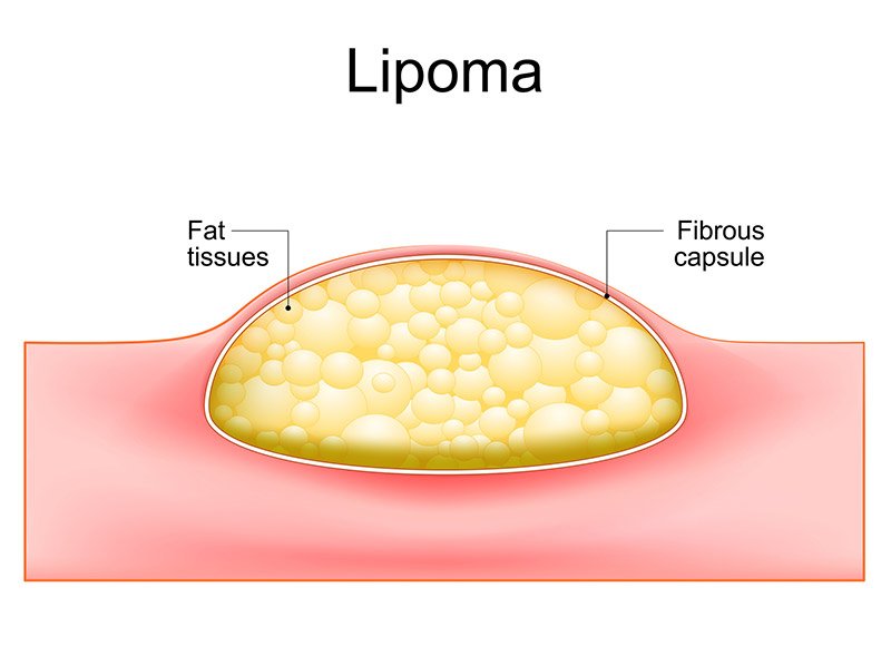 lipoma img1 2 lipoma img1 2
